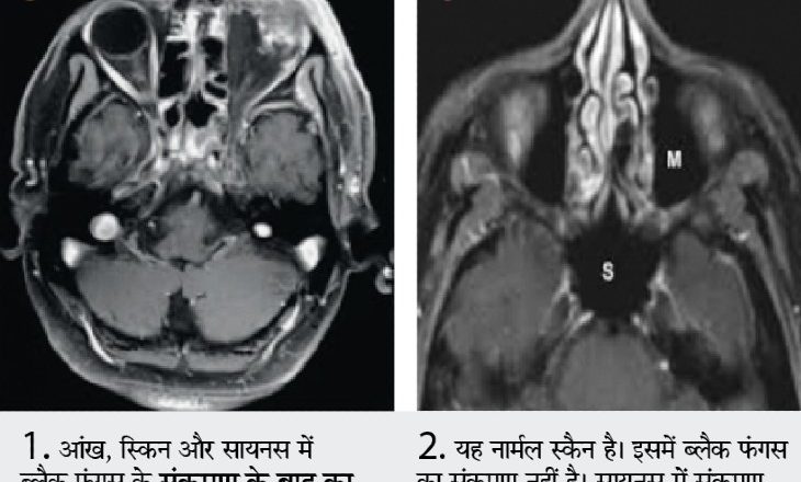 संक्रमण के साथ अब फंगल आक्रमण:भाेपाल में 10 दिन में 50 लोगों में ब्लैक फंगल इंफेक्शन, आंखों की राेशनी पर असर